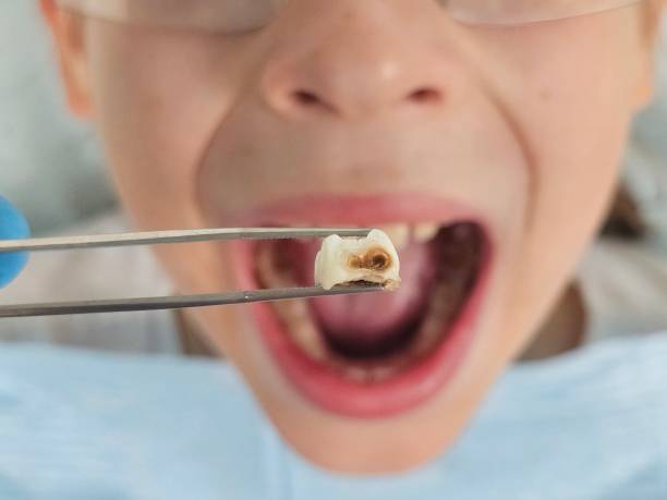 Best Emergency Tooth Extraction in Thomasville, AL